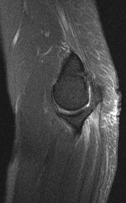 Figure 5 for case Ulnar neuritis and denervation of the flexor digitorum profundus